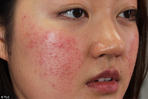 Dị ứng mỹ phẩm thường xuất hiện mụn kèm theo biểu hiện sưng tấy và ngứa ngáy trên da mặt