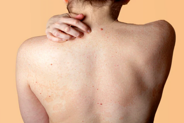 Mụn nổi nhiều ở lưng có thể báo hiệu một số loại bệnh