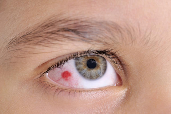 Các đốm đỏ trong mắt thường sẽ tự khỏi sau vài ngày hoặc 1 tuần