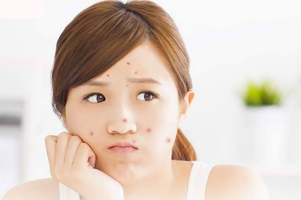 Chăm sóc da ở tuổi dậy thì đóng vai trò quyết định sức khỏe làn da sau này