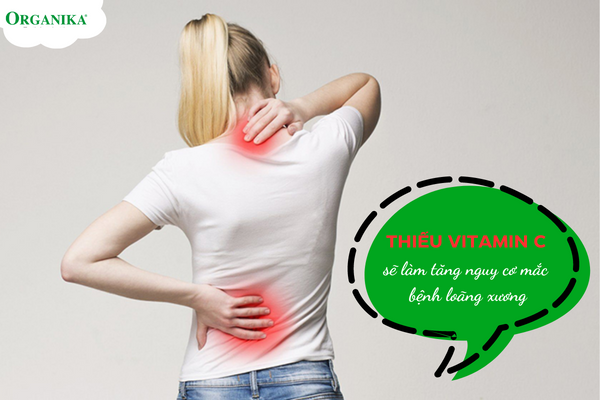 Người bị thiếu Vitamin C thường có nguy cơ mắc bệnh loãng xương cao
