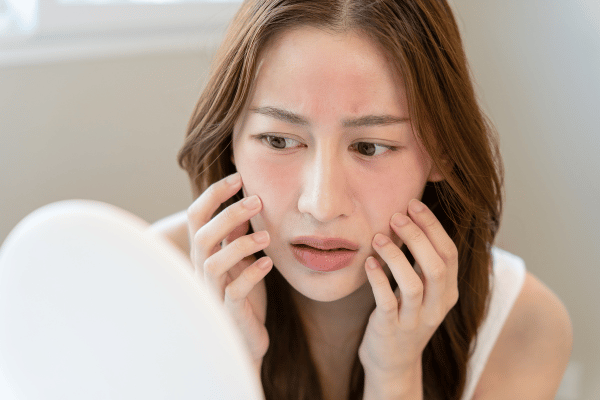 Cháy nắng là vấn đề da thường gặp khi đi du lịch