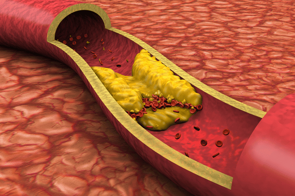 Thay đổi chế độ ăn uống để làm giảm cholesterol trong máu
