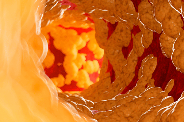 Mỡ máu cao là tình trạng rối loạn chuyển hóa lipid máu