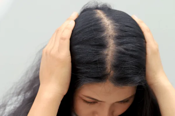 Rụng tóc sau sinh do căng thẳng và thiếu ngủ